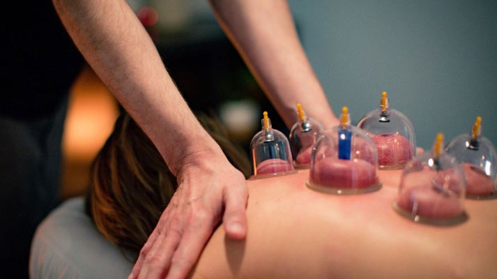 Cupping Therapy