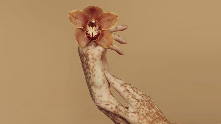 Skin Disorders: More Than Skin Deep
