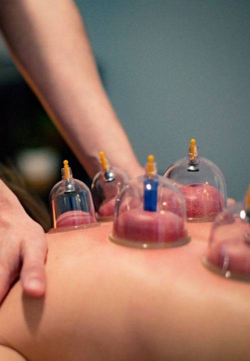 Cupping Therapy